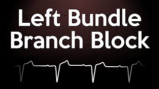 Left Bundle Branch Block ECG Explained [upl. by Norabel994]