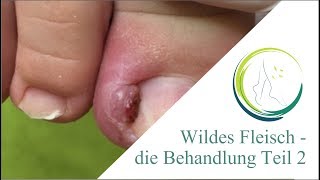 Wildes Fleisch die Behandlung Teil 2 [upl. by Lossa]