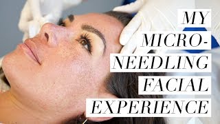 My Microneedling Facial Experience [upl. by Greenburg995]