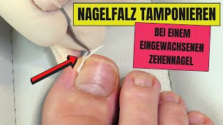 Nagel tamponieren bei EINGEWACHSENEN NÄGELN  Eingewachsene Nägel endlich loswerden [upl. by Aksel]