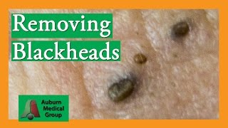 Several Blackheads  Auburn Medical Group [upl. by Northrup]