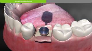 Biotech Dental Protocole chirurgical de pose dun implant dentaire KONTACT souscrestal [upl. by Nikolai]