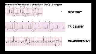 EKG Patterns  Premature Atrial amp Ventricular Contractions PACs amp PVCs [upl. by Yerbua514]