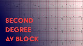 Second Degree Heart Block  Electrocardiogram ECGEKG Interpretation [upl. by Gnagflow585]