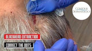 Blackheads Extraction From Behind the Head Connect The Dots [upl. by Uthrop837]