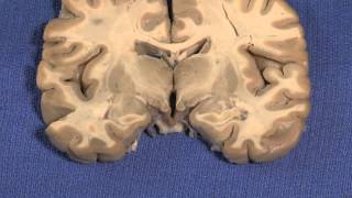 Spinothalamic Tract  Ascending Tracts  Spinocerebellar Tract  Neuroanatomy [upl. by Annahavas]