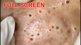 LARGE Blackheads Removal  Best Pimple Popping Videos [upl. by Bernadine294]