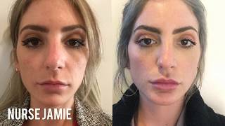 Before and After Micro Needling  Nurse Jamie [upl. by Nebuer]