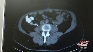 HIPEC for signet ring cell carcinoma [upl. by Akisey]