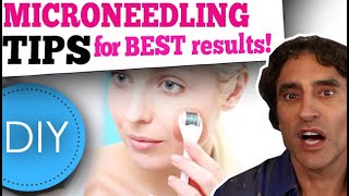 MICRONEEDLING DIY at HOME  What You Need to Know [upl. by Laniger292]