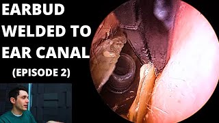 Ear Bud Welded To Ear Canal Episode 2 [upl. by Ahsenrad]