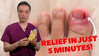 6 HOME REMEDIES To Treat A PAINFUL Ingrown Nail  Dr Kim [upl. by Eidac]