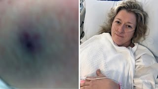 Mother Talks About Surviving Funnel Web Spider Bite [upl. by Borroff]