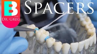 BRACES EXPLAINED Spacers [upl. by Ellenaej]