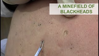 A Minefield of Blackheads  Dr Derm [upl. by Casabonne]