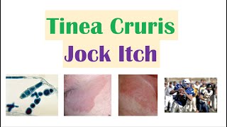 Jock Itch Tinea Cruris  Causes Risk Factors Signs amp Symptoms Diagnosis and Treatment [upl. by Northrup]