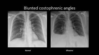 Pleural Effusions [upl. by Anurag]