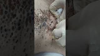 Nevus Comedonicus removal [upl. by Caldera]