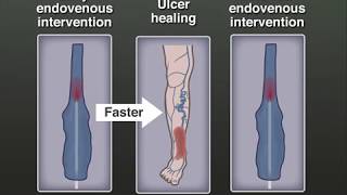 Treating Venous Leg Ulcers [upl. by Allistir]