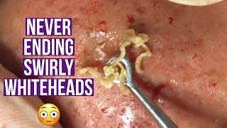 Blackhead and whitehead extractions relaxing amp satisfying [upl. by Enilehcim832]