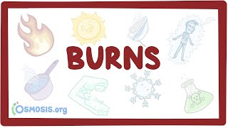 Burns  an Osmosis Preview [upl. by Aelam78]