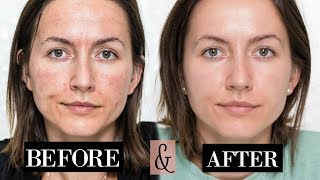 My MICRONEEDLING Experience  Skin Updates  Before amp After [upl. by Buddie941]