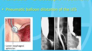 Treatment of Achalasia [upl. by Ariane]