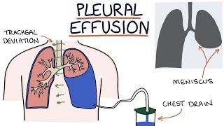 Understanding Pleural Effusions [upl. by Shanks826]