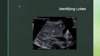 Ultrasound and Liver Segments [upl. by Rosene156]