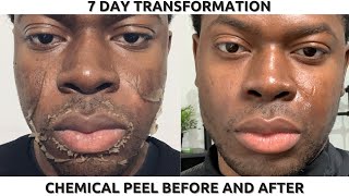 CHEMICAL PEEL ON BLACK SKIN  FULL PROCESS BEFORE amp AFTER  HYPERPIGMENTATION amp DARK SPOTS [upl. by Dewees]