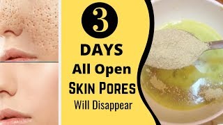 3 Days and All Open Pores Will Disappear from Your Skin Forever [upl. by Koehler]