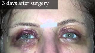 Upper Eyelid Surgery  After Photos 3 Days Post Surgery  8 West Clinic in Vancouver BC [upl. by Enimrej562]