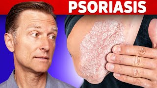 Psoriasis Treatment – The Best 3 Remedies for Psoriasis – DrBerg [upl. by Anairam]