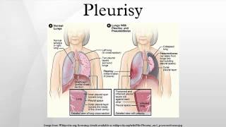 Pleurisy [upl. by Bolger]