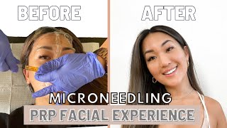 Full PRP Facial  Microneedling Experience  BeforeAfter Recovery [upl. by Atilol]