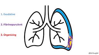 Empyema and Pleural Effusions [upl. by Aramaj678]