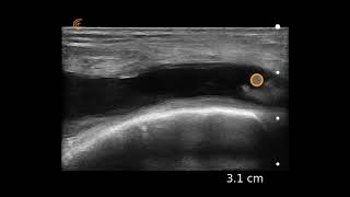 Knee Effusion Ultrasound Image Interpretation [upl. by Herrington]