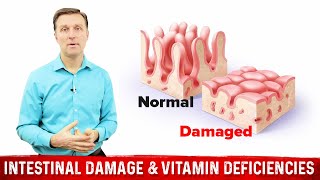 Intestinal Obstruction amp Vitamin Deficiencies – Dr Berg [upl. by Palladin119]