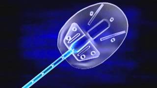 How Does the Ahmed Valve Work [upl. by Harbard]