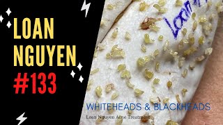 Removal whiteheads and blackheads 133 [upl. by Ttenna]