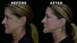 Unbelievable Before and Afters of Neck Lift [upl. by Nwahsit562]