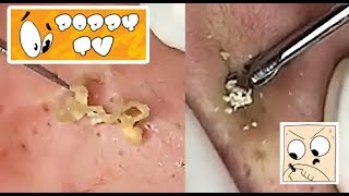 Large Closed Comedones  Whiteheads Extraction [upl. by Thetisa]