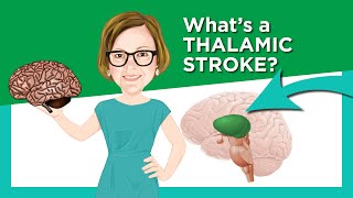 Thalamic Stroke [upl. by Ennylcaj203]