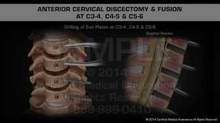 Anterior Cervical Discectomy amp Fusion at C34 C45 amp C56 [upl. by Eresed]