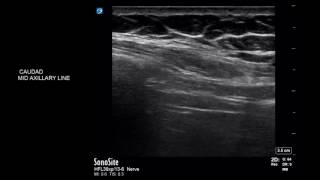 Neonatal Neurosonography  Anatomy and Protocol [upl. by Lucius325]