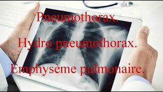 Pneumothorax  Hydro pneumothorax  Emphysème pulmonaire [upl. by Gibbs665]