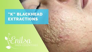 Blackheads Whiteheads Extractions on quotKquot Part 1 [upl. by Schulz836]